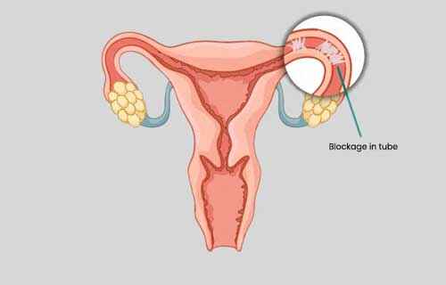 Blocked fallopian Tubes