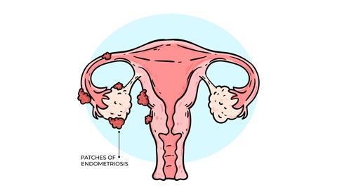 Endometriosis